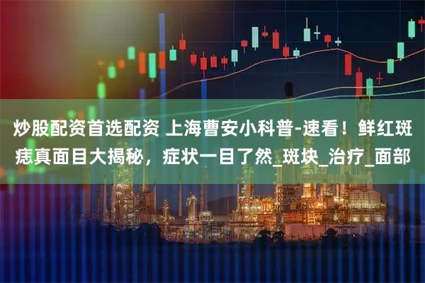 炒股配资首选配资 上海曹安小科普-速看！鲜红斑痣真面目大揭秘，症状一目了然_斑块_治疗_面部